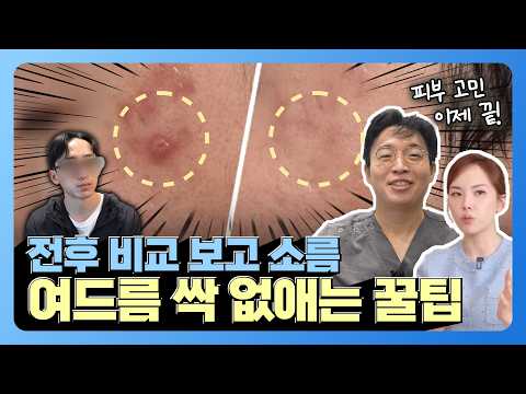 Real Acne Treatment Review
