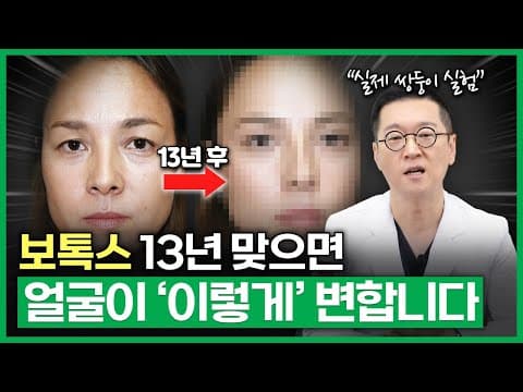 What 13 Years of Botox Does to Your Face