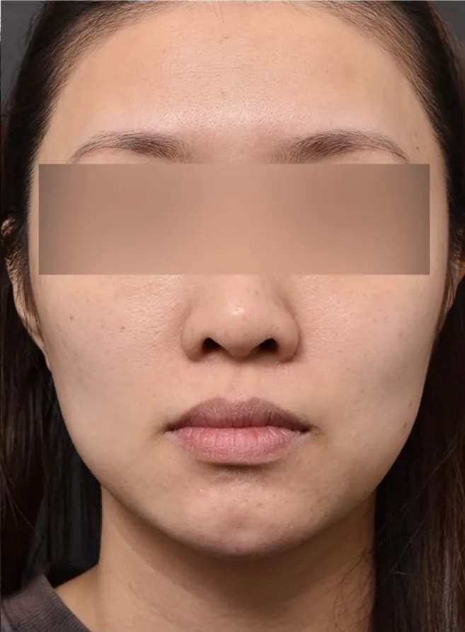 Patient case 1 after treatment, front view of the lower face