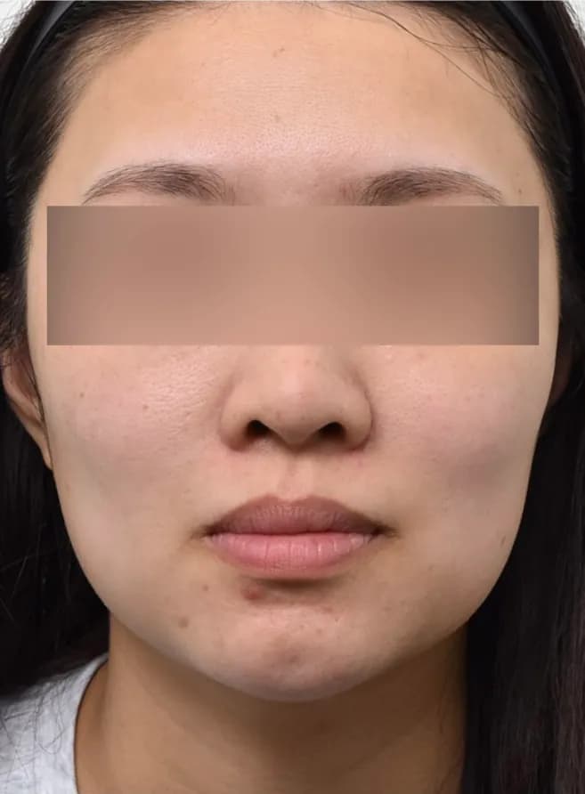 Patient case 1 before treatment, front view of the lower face