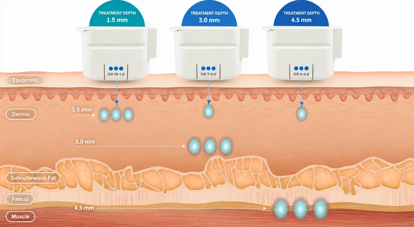 Illustration of Ultherapy transducers delivering focused ultrasound at 1.5, 3.0, and 4.5 mm beneath the skin